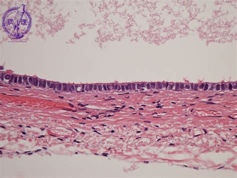 15female Genital Organs 6 Serous Cystadenomapathology Core Pictures