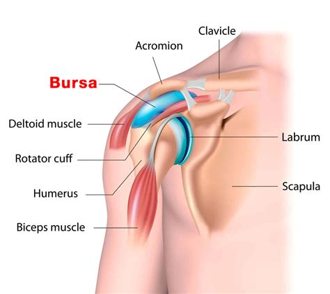 Bursitis de hombro síntomas causas tratamiento con aparatos