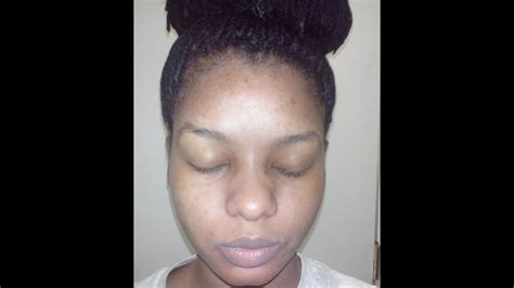 How Kojic Acid Soap Changed My Face Week 4 Before And After Pictures