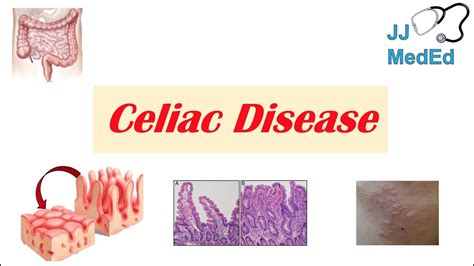 Celiac Disease And Gluten Sensitivity Risk Factors Pathogenesis