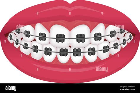Dental Braces Vector Illustration No Text Stock Vector Image And Art Alamy