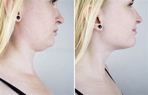 Second Chin Lift In Women Photos Before And After Plastic Surgery