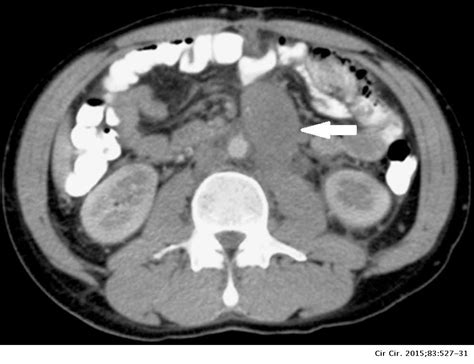 Bilateral And Synchronous Testicular Teratoma A Case Report And