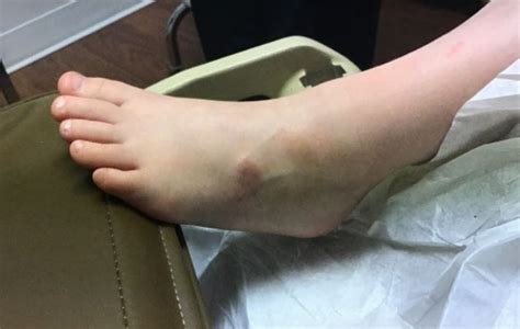 Derm Dx Asymptomatic Lesion On The Foot Dermatology Advisor
