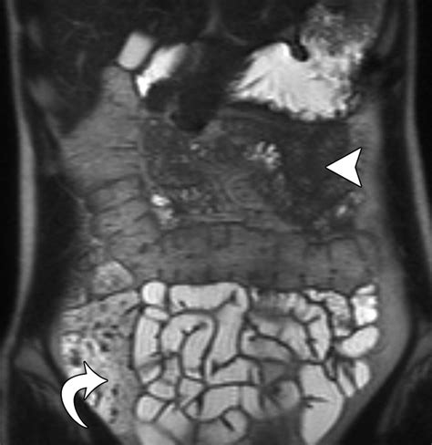 Mr Enterographic Manifestations Of Small Bowel Crohn Disease