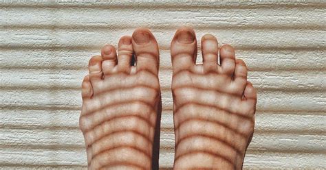 Red Toes Symptoms Causes And Treatments