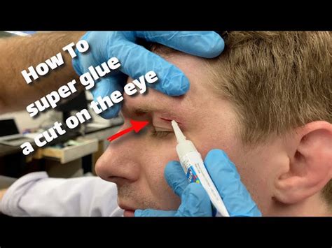 How To Treat A Cut On Your Eyelid To Get Ideas