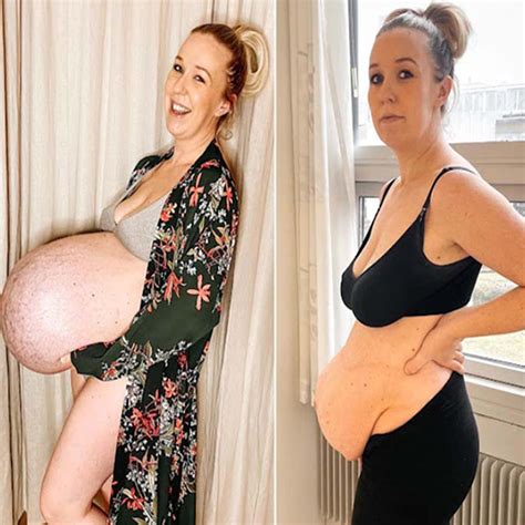 The Mother Of Triplets Shared Her Belly D Ri G Preg A Cy A D Postpart M