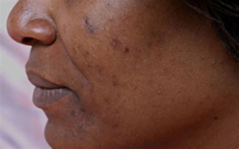 The Easiest Ways To Get Rid Of Black Skin Spots