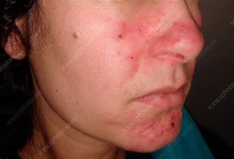 Acne Rosacea Stock Image C0372742 Science Photo Library
