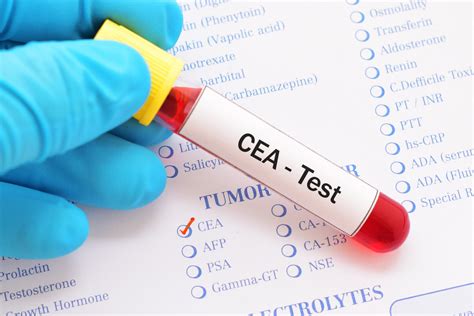 Understanding The Cea Test In Colon Cancer Cancerconnect