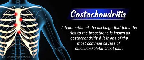 Costochondritis Treatment