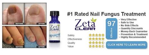 Zetaclear Not Only Cures You Fungal Infection But Also Prevents It