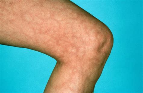 Skin Manifestations Of Chronic Hepatitis C Virus Infection Infectious