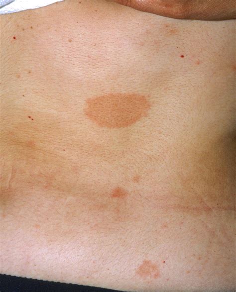 What Causes Pityriasis Rosea Rash Porn Sex Picture