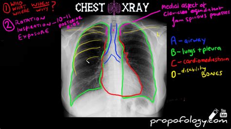 Learn To Read A Chest Xray In Minutes Youtube