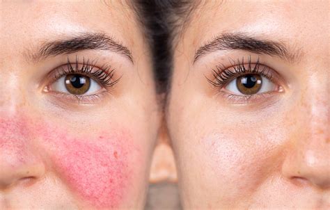 How To Treat Rosacea Symptoms Causes And Treatment Options Health