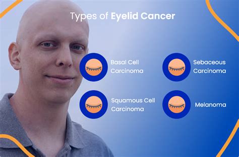 Eyelid Cancer Everything You Need To Know Actc