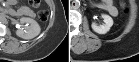 Findings On Intraprocedural Non Contrast Computed Tomographic Imaging