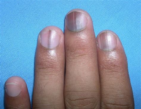 It can be hereditary, trauma induced, smoking, some skin conditions like lichen planus, where. 10 Diseases that Show up In Your Nails - Smashing Tops