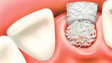 Broken Teeth Replace A Cracked Tooth Elite Dental Group