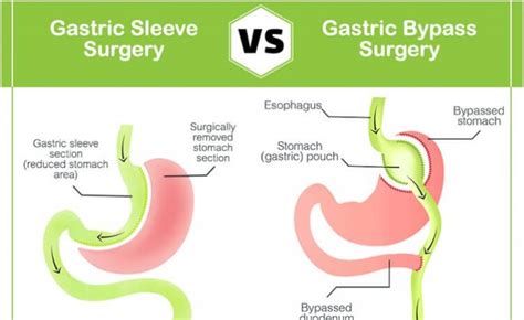 Gastric Bypass Vs Gastric Sleeve Which One Is Right For You Fitness