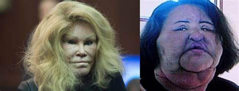 Plastic Surgery Cases That Have Gone Extreme Science Times