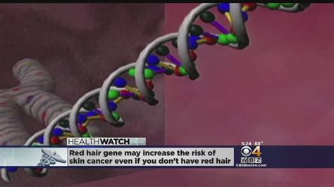 Hidden Red Head Gene May Increase Risk Of Skin Cancer Youtube