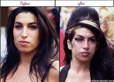Plastic Surgery Amy Winehouse Winehouse