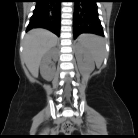 Properitoneal Fat Mimicking Intraperitoneal Air Radiology Case