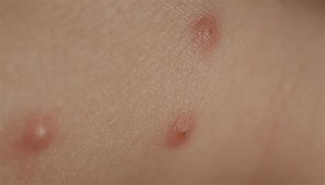 Images Of Bed Bug Bites On African American Skin To Accurately