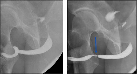 Anterior Urethral Strictures And Retrograde Urethrography An Update For Radiologists Clinical