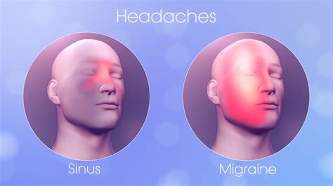 Your Sinus Headache Could Be Migraine Scientific Animations