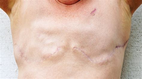 Double Mastectomy With Immediate Reconstruction