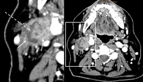 Radiological Detection Of Extracapsular Spread In Head And Neck