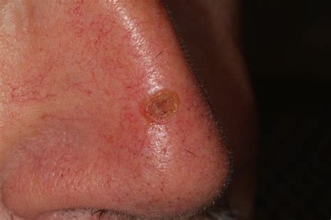 Red Spot Skin Cancer On Nose