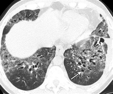 Nonspecific Interstitial Pneumonia Radiologic Clinical And