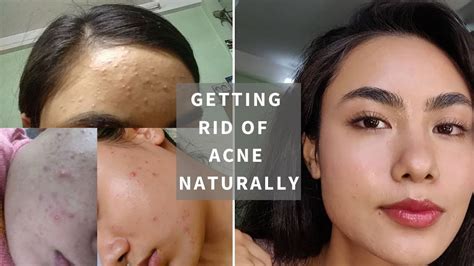 How I Got Rid Of My Acne Naturally 8 Tips That Works 100 Youtube
