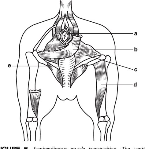 Figure 3 From A Review Of The Surgical Management Of Perineal Hernias