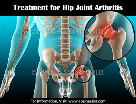 Hip Joint Arthritistypescausessignssymptomstreatmentsurgery