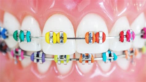 What Braces Colours To Get How To Pick The Best Option For You