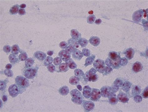 Figure 3 From Carcinoma Showing Thymus Like Differentiation Castle