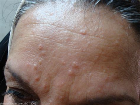 Clear Pimples Cream Face Bumps Treatment Acnesil
