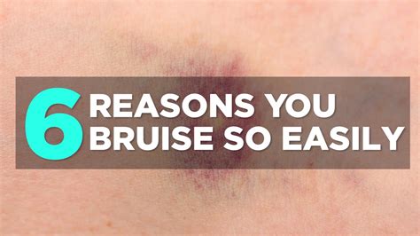Reasons Youre Bruising Easily