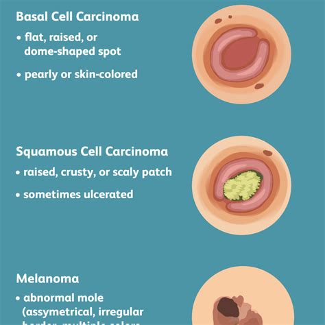 35 Types Of Skin Cancer Symptoms Pics Eyebrow Ideas