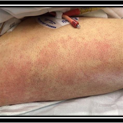Rash Non Specifical Blanching Erythematous Rash On The Lower