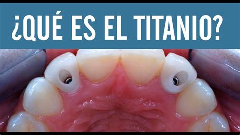 Qué es el titanio Juan Fernando Salgado Los implantes dentales