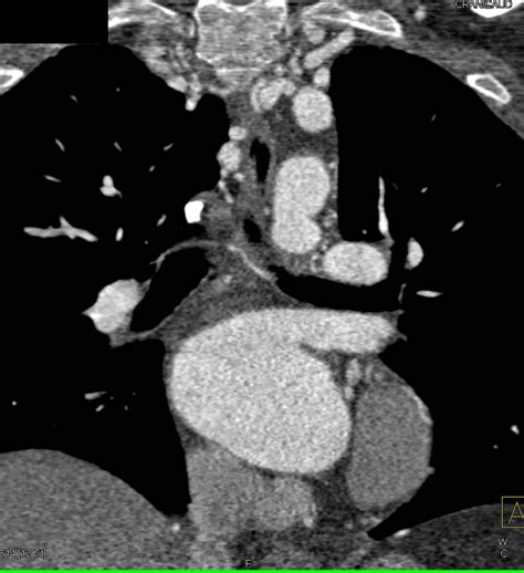 Coarctation Of The Aorta With Intercostal Collaterals And Dilated