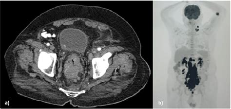 A The Abdominal Ct Scan Showing A Mass Protruding And Nearly