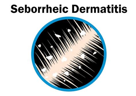 Seborrheic Dermatitis Symptoms Causes Treatment And Prevention Richfeel